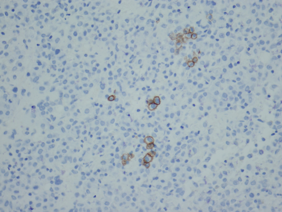 The bone marrow core demonstrates only focal immunoreactivity of erythroid progenitors for E-cadherin. (E-cadherin; 400x magnification)